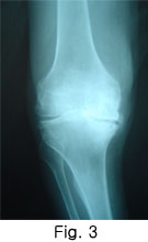 Hi-flexion Total Knee Arthroplasty