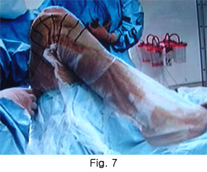 Hi-flexion Total Knee Arthroplasty